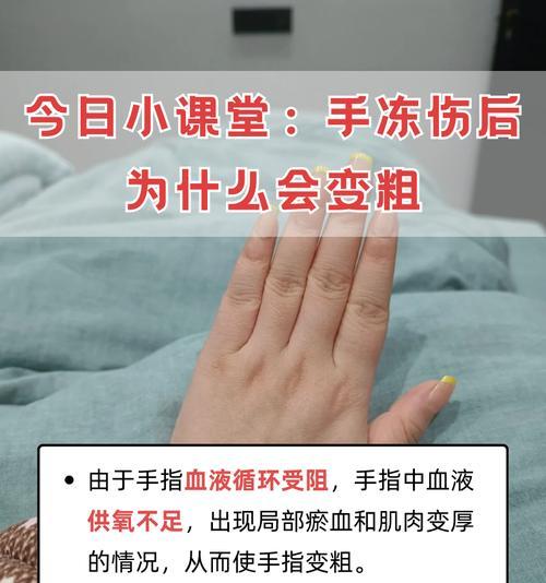 红掌冻伤了怎么办？（预防、处理和康复的关键措施）